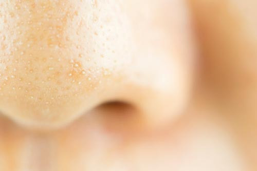 Mụn trứng cá: Nguyên nhân, cách nhận biết và giải pháp hiệu quả