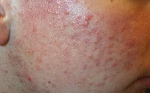 Mụn trứng cá: Nguyên nhân, cách nhận biết và giải pháp hiệu quả