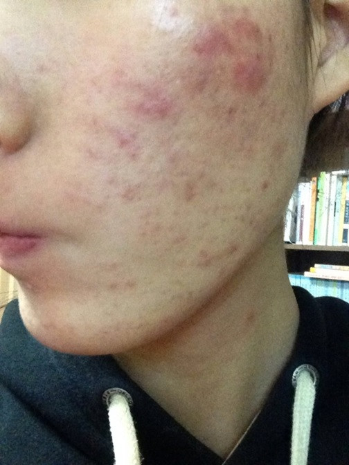 Tác dụng của Retinol Obagi – vì sao không nên dùng để trị mụn?