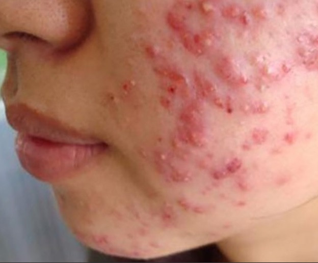 Tác dụng của Retinol Obagi – vì sao không nên dùng để trị mụn?