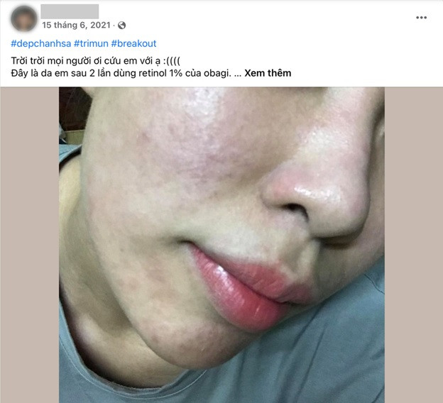 Tác dụng của Retinol Obagi – vì sao không nên dùng để trị mụn?