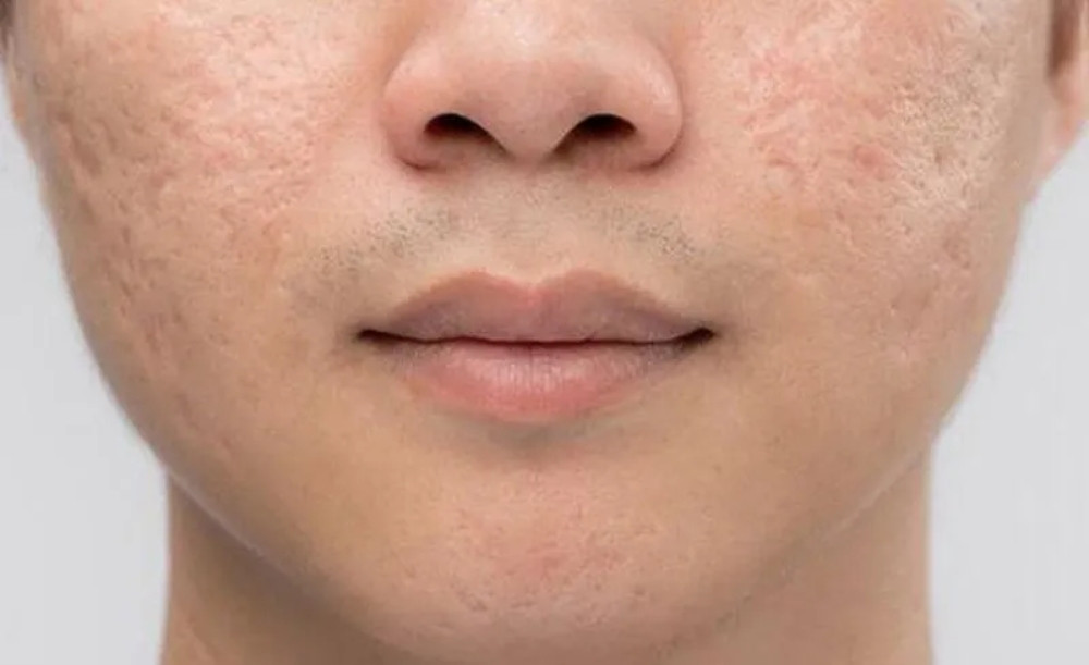 Tác Dụng Tuyệt Vời Của Dầu Dừa Trong Chăm Sóc Da
