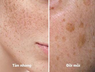 Tàn nhang: Nguyên nhân và phương pháp điều trị hiệu quả