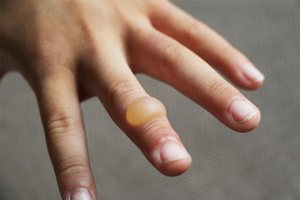 Tìm Hiểu Về Mụn Nước: Nguyên Nhân, Triệu Chứng Và Cách Điều Trị
