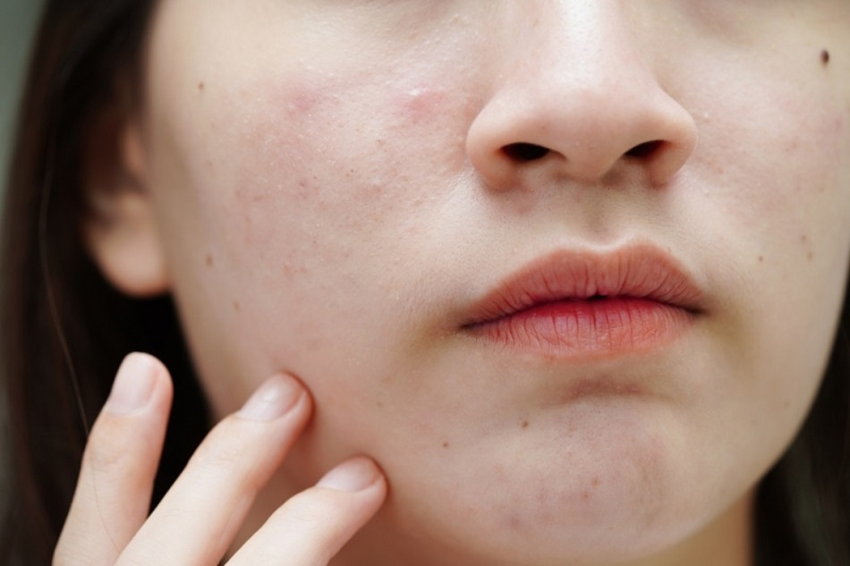 Top 13 Sữa Rửa Mặt Dành Cho Da Dầu Mụn Nhạy Cảm Hiện Nay