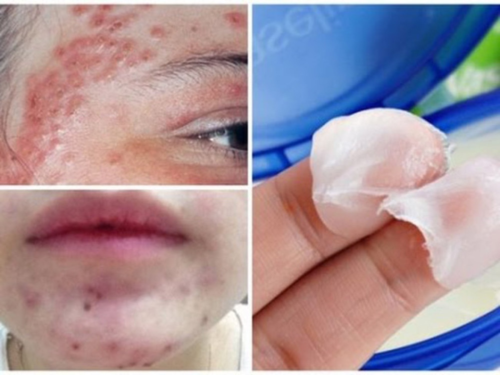 Vaseline Có Dưỡng Da Mặt Được Không? Những Điều Bạn Cần Biết